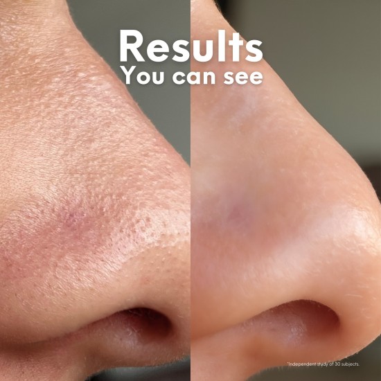 Skin Choice Breakout Patch Classic Nose 5's