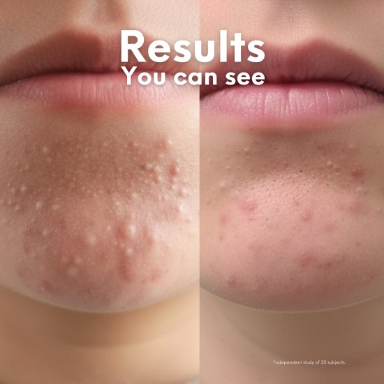 Skin Choice Breakout Patch Classic Xtra 10's